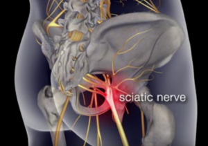 sciatica sos review