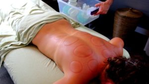 Sports and Orthopedic Cupping