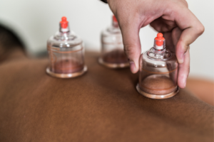 cupping for pain